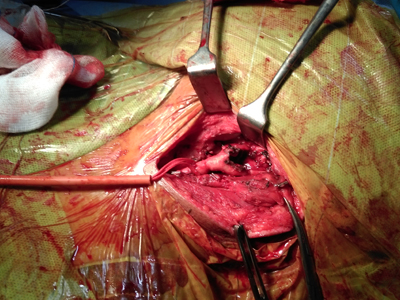 Carotid Body Tumor