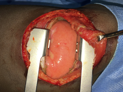 Congenital Lobar Resection