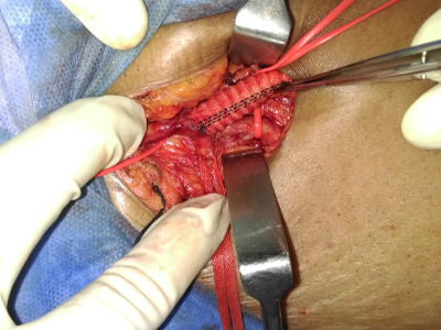 Femoral Anastomosis