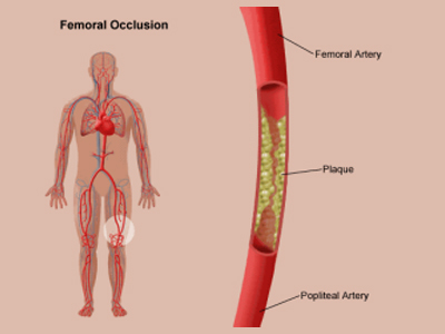 Femoro Popliteal