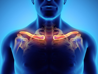 Thoracic Outlet Syndrome