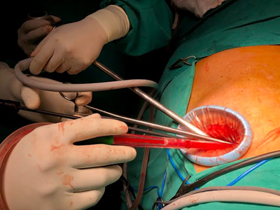 Thoracoscopic Surgeries